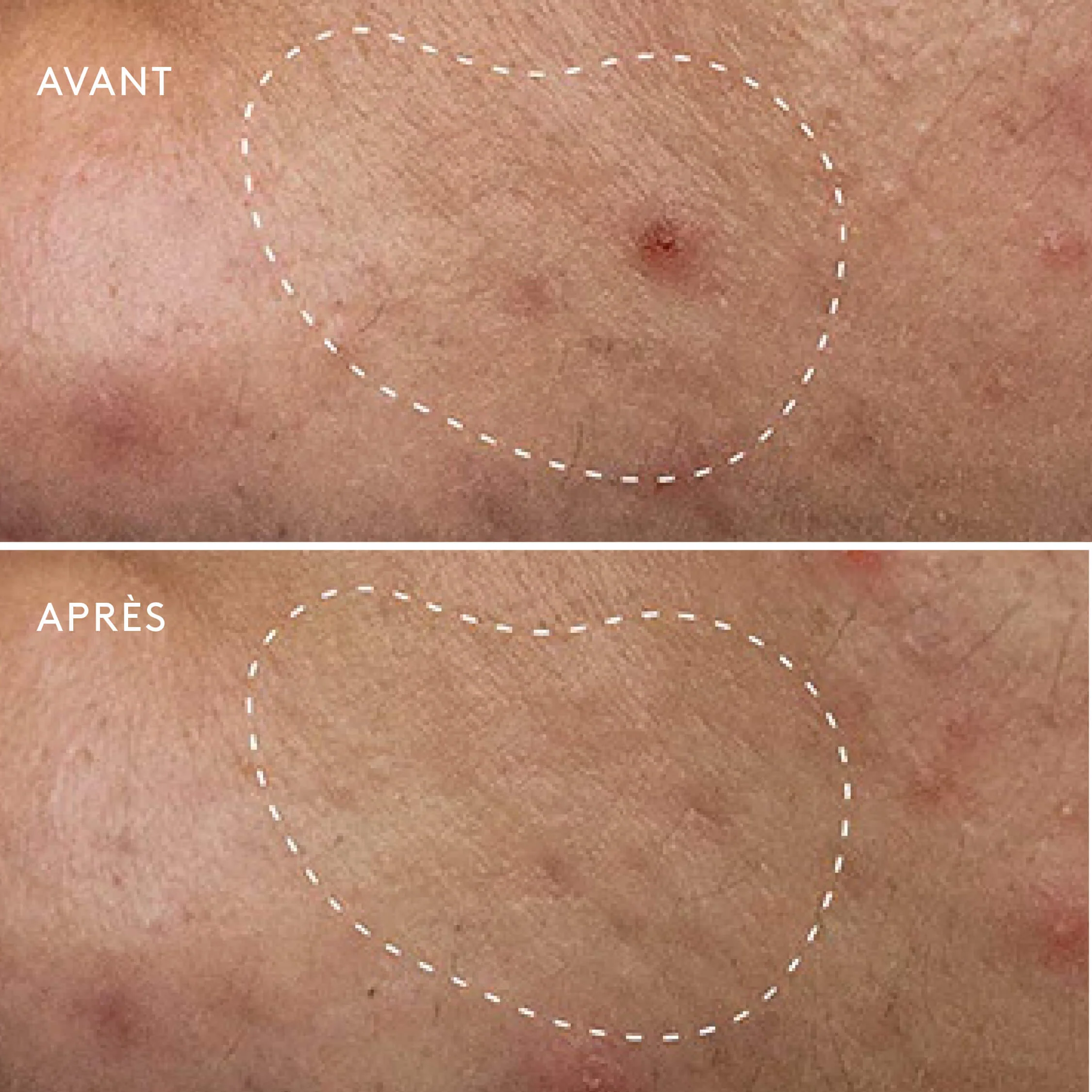 Deep Breakout Anti-Blemish Liquid Patch - Image 2